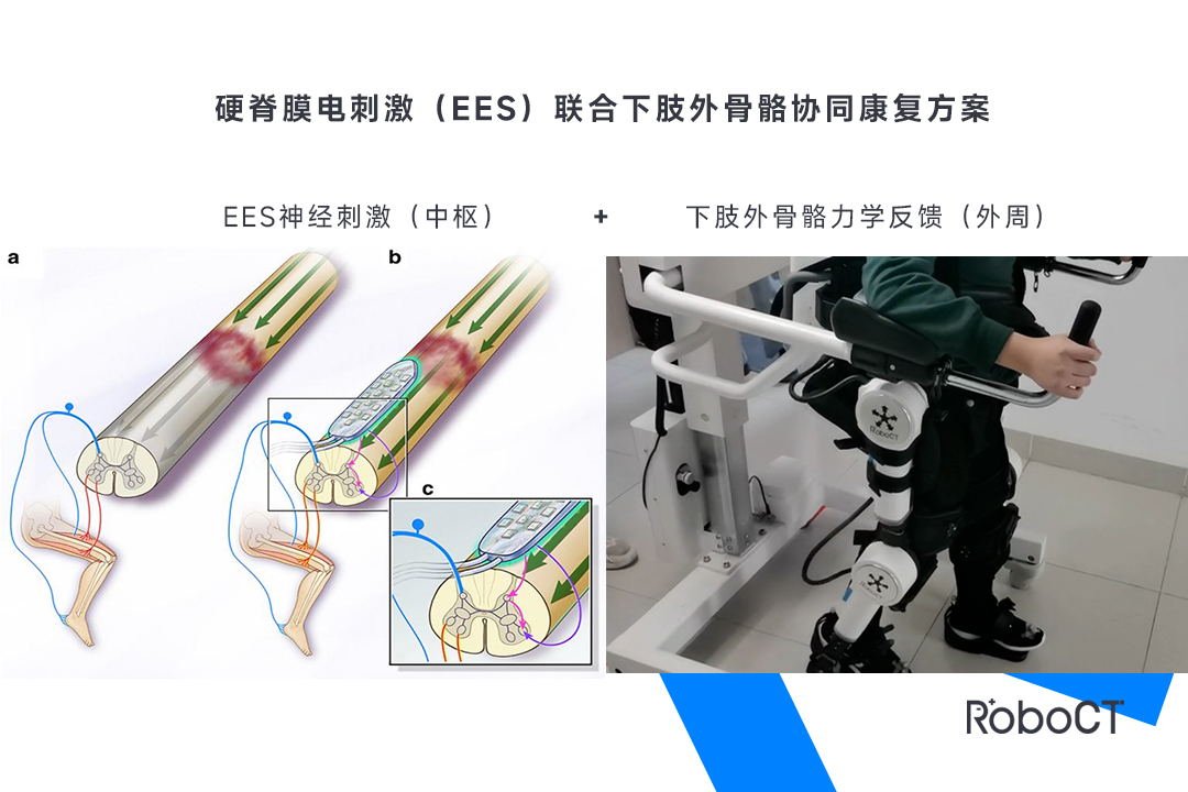 脊髓電刺激-2.jpg
